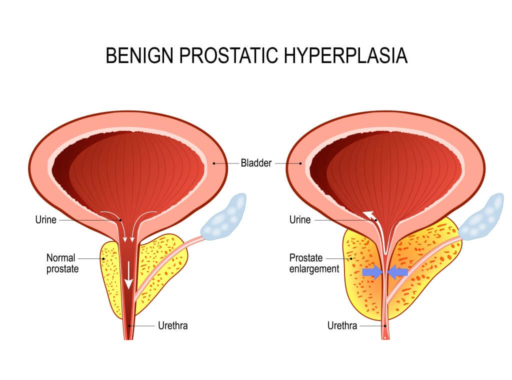 Benign Prostatic Hyperplesia